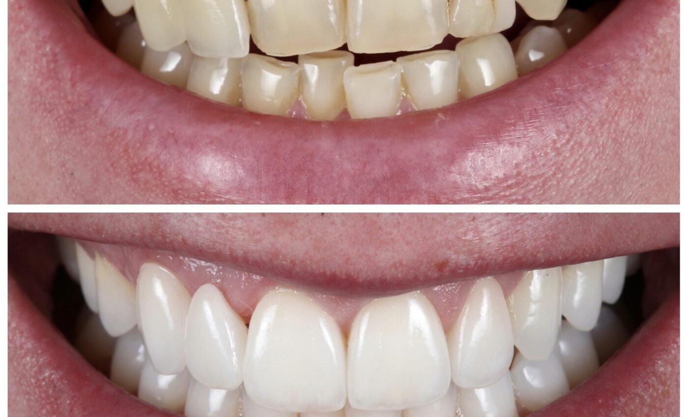 We’re back…Big dental procedures on the horizon…School holiday ends in 4 days…